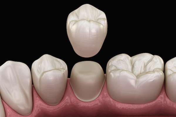 What To Ask Your General Dentist When Preparing for a Crown from Michael M. Bohn, DDS in Fresno, CA