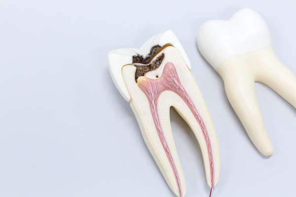 Ask a General Dentist: Is a Tooth Dead After a Root Canal from Michael M. Bohn, DDS in Fresno, CA