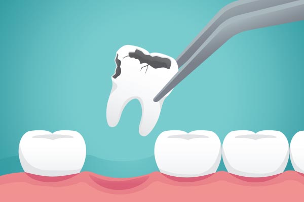 Ask a General Dentist: What Happens to Your Tooth After Extraction from Michael M. Bohn, DDS in Fresno, CA