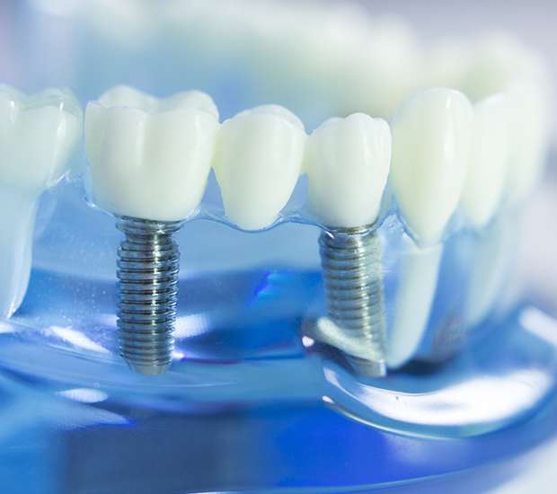 Fresno Dental Implants