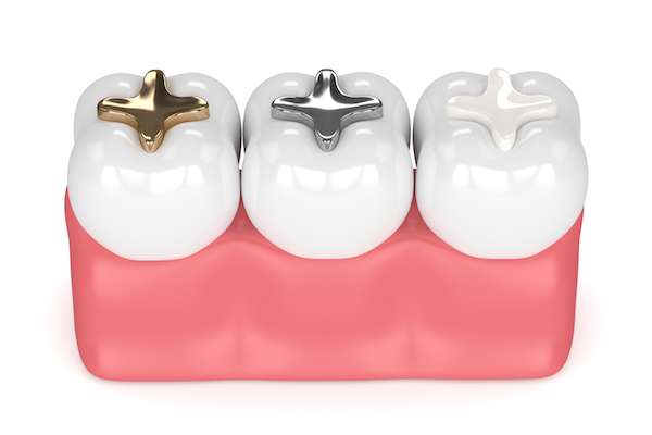 A General Dentist Discusses Different Filling Options from Michael M. Bohn, DDS in Fresno, CA